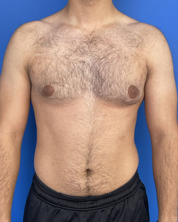 Gynecomastia asymmetric grade 2B before surgery, case 3009 - front view