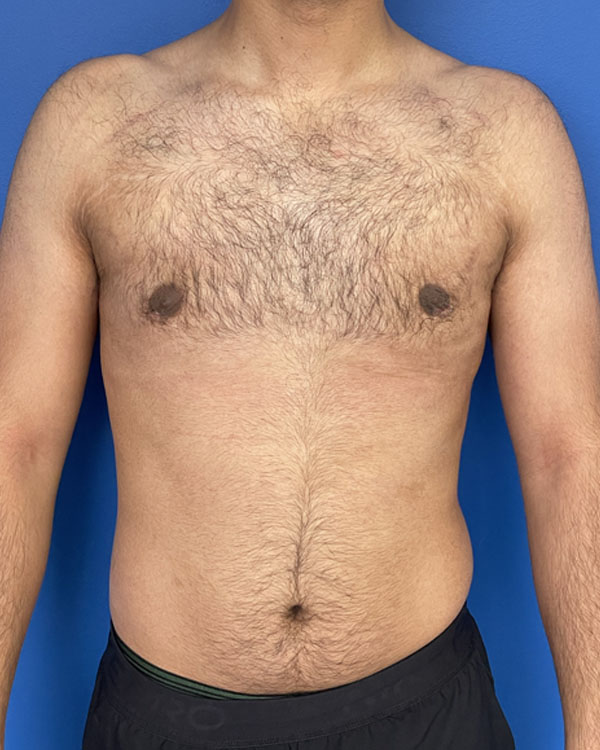 Gynecomastia 4 weeks after surgery, case 3009 - front view