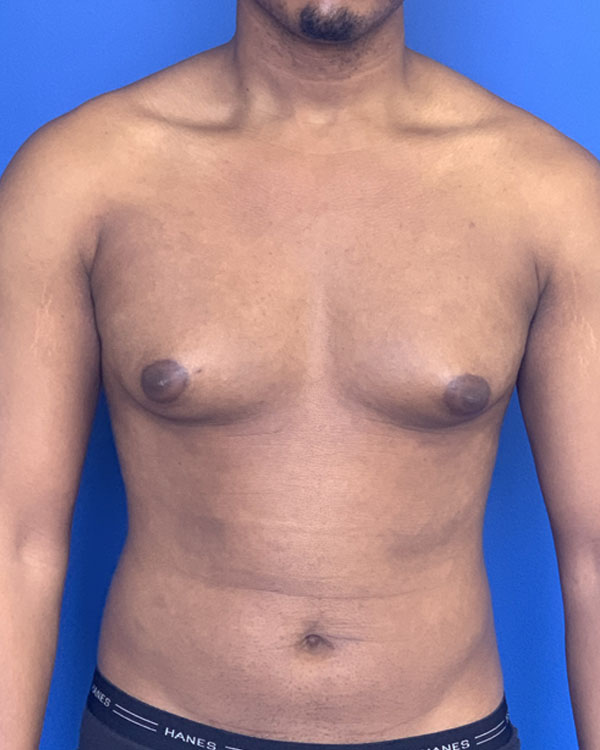 Gynecomastia grade 2B before surgery, case 3008 - front view
