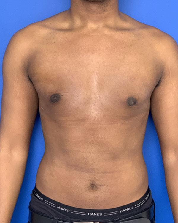 Gynecomastia 6 weeks after surgery, case 3008 - front view